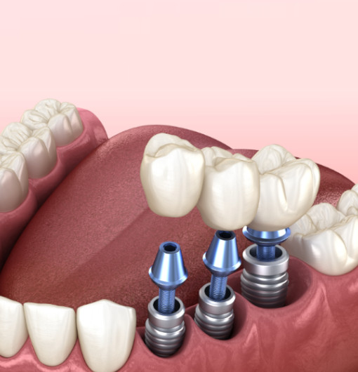Dental Implants